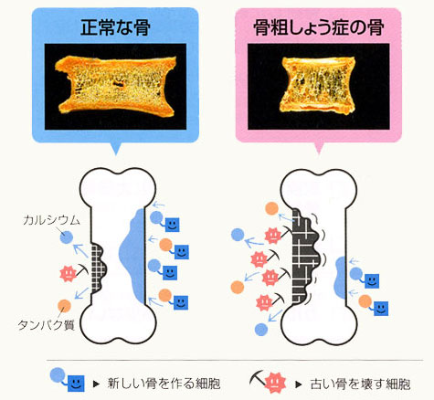 正常な骨と骨粗鬆症の骨